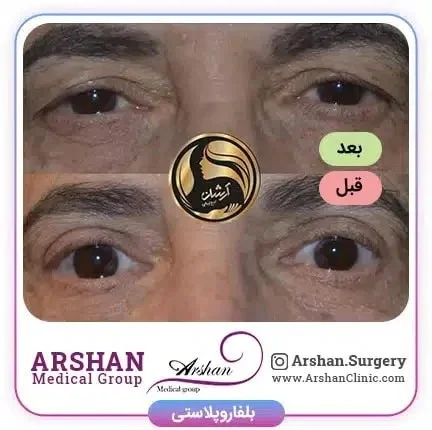 عمل بلفاروپلاستی چه مزایا و عوارضی دارد؟