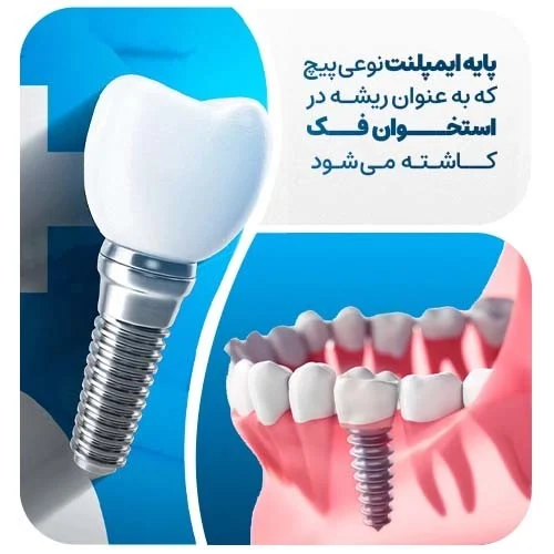 قالب گیری ایمپلنت