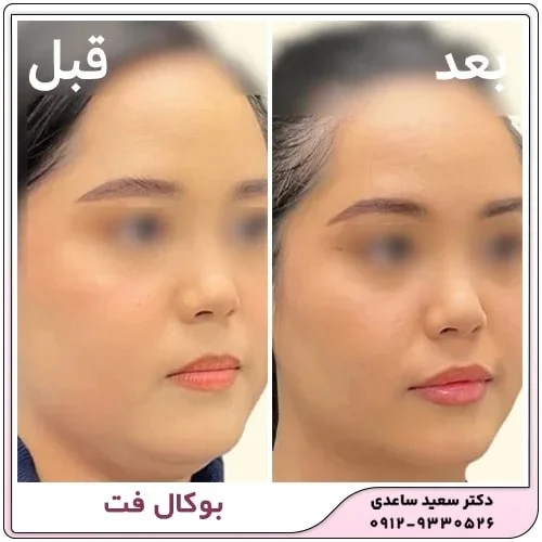 ماندگاری عمل بوکال فت چقدر است؟