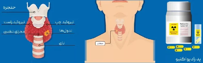 بیماری ید درمانی در درمان سرطان تیروئید چه تأثیری دارد؟