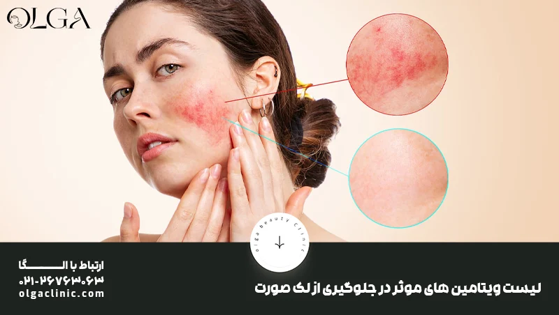 لیست ویتامین های موثر در جلوگیری از لک صورت